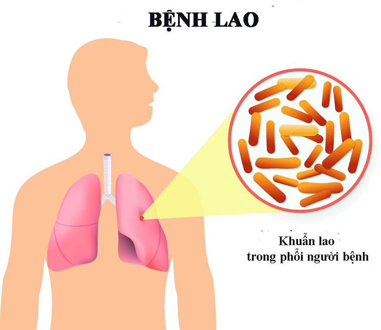 benh-lao-17109477013122039813647